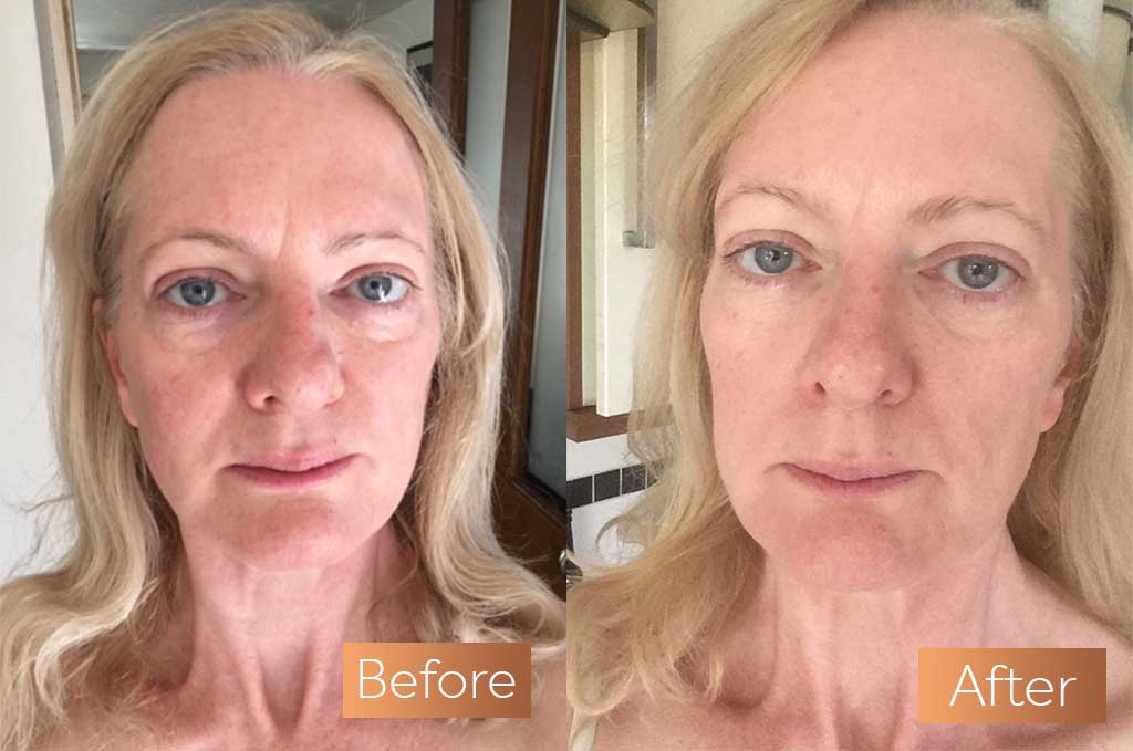 Stunning Collagen Before and After Transformations: What to Expect