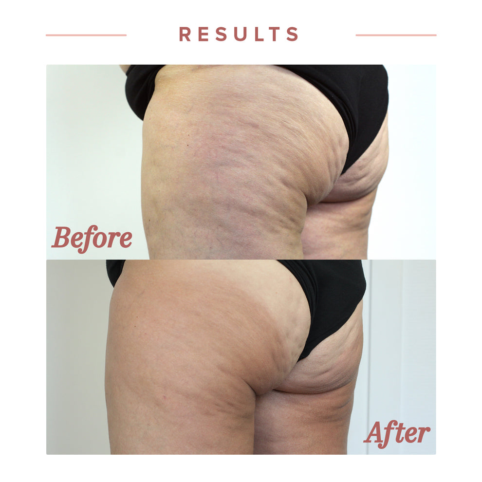 The Best Cellulite Treatment Near Me: Discover for Smooth Skin